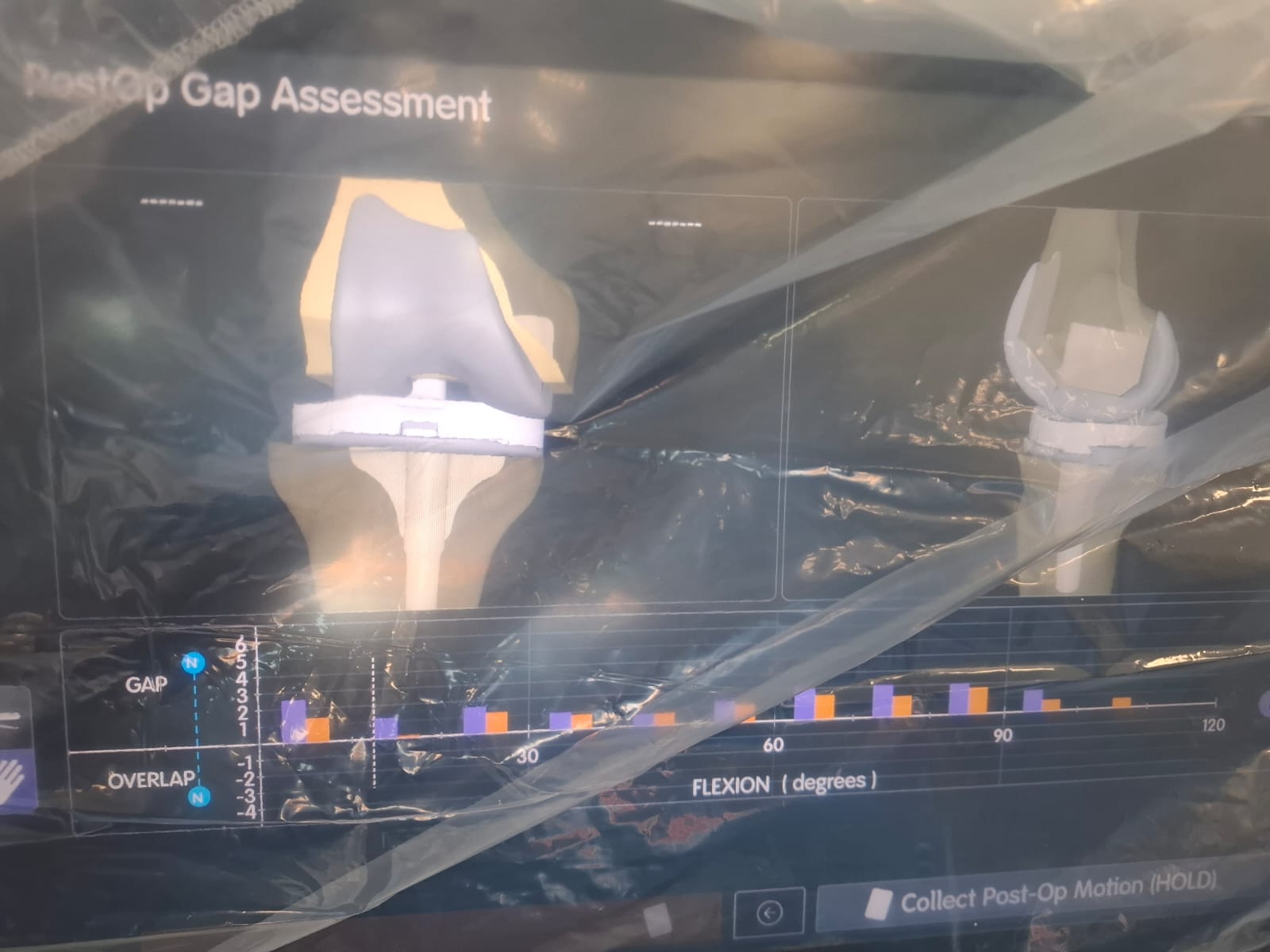 Knee X-ray 22