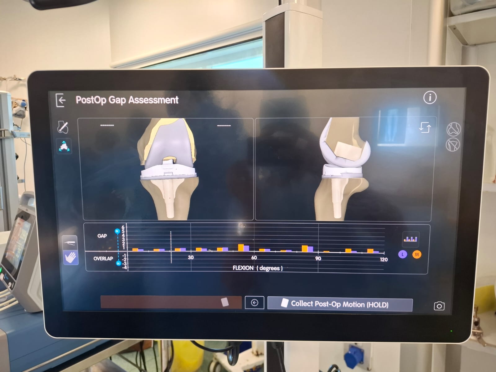 Knee X-ray 62