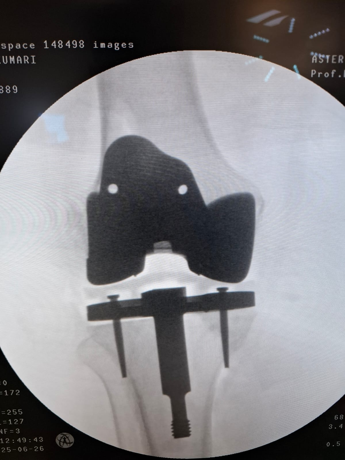 Knee X-ray 71