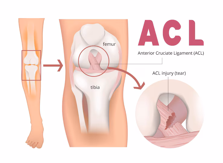 ACL Surgery